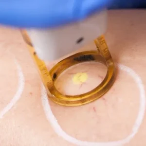 Veins, Vascular Lesions, Pigmented Lesions